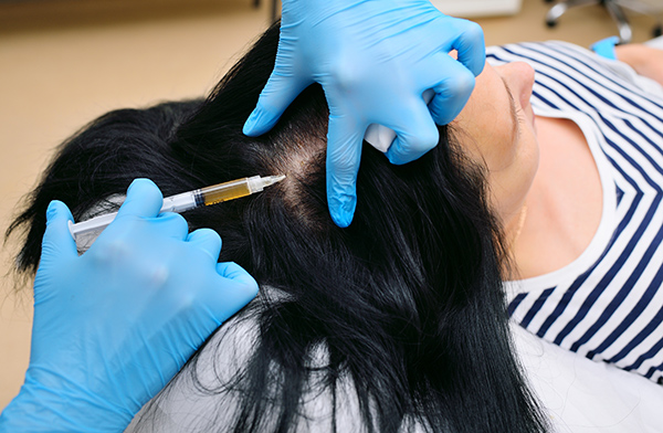 PRP-womens-hair-loss-treatment-Toronto