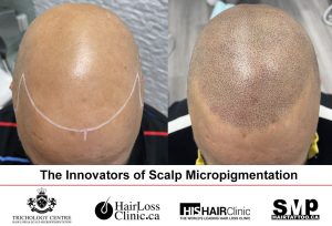 Vipin Scalp Micropigmentation Toronto