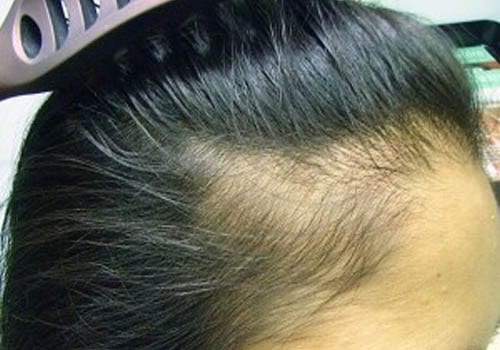 hair loss women experience - traction alopecia Toronto