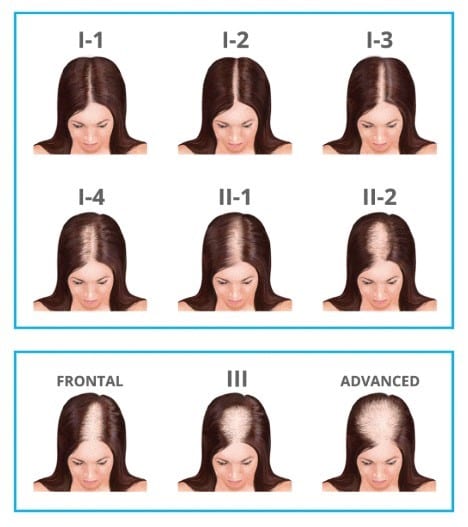 Hair Loss Women - Assessment and Treatment 