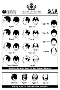 male pattern baldness Norwood Scale Toronto