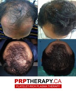 PRP in hair treatment Toronto
