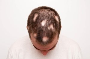 hair loss treatment men