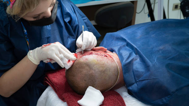 hair transplant Toronto cost