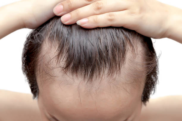 how can I stop my female hair loss