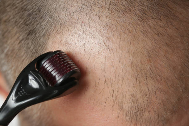 microneedling toronto hair loss treatment