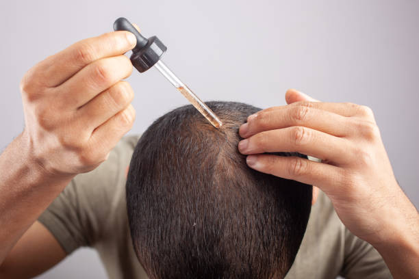 minoxidil hair loss treatment