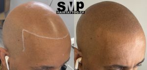 scalp-micropigmentation-Toronto
