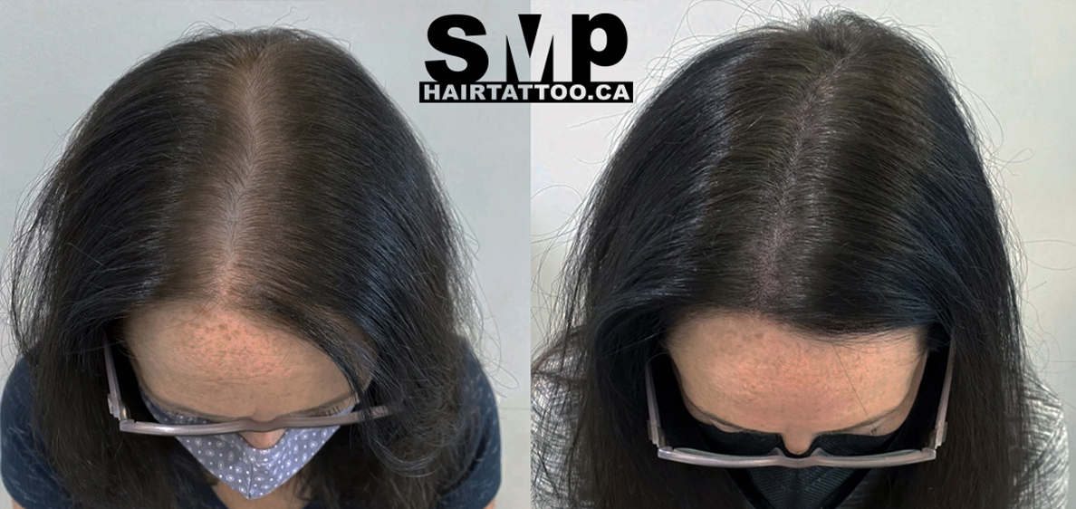 scalp-micropigmentation-for-women