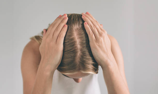 women hair loss Toronto