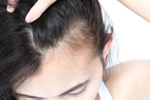 womens hair loss - telogen effluvium