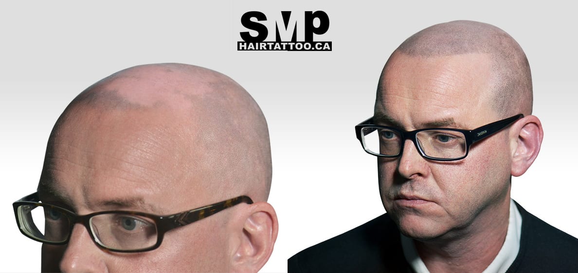 Chris-scalp micropigmentation after 5 years