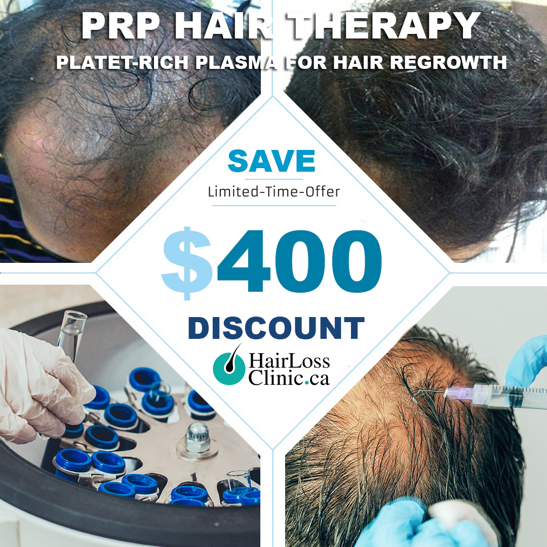 PRP treatment - PRP hair treatment