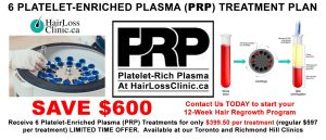 PRP treatment Toronto - PRP for hair loss before and after - PRP microneedling before and after