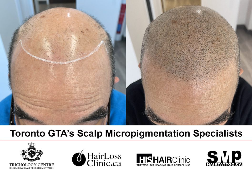 scalp micropigmentation before and after