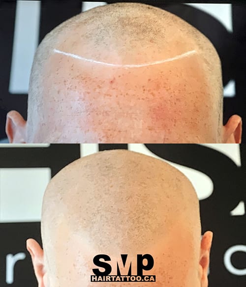 best scalp micropigmentation