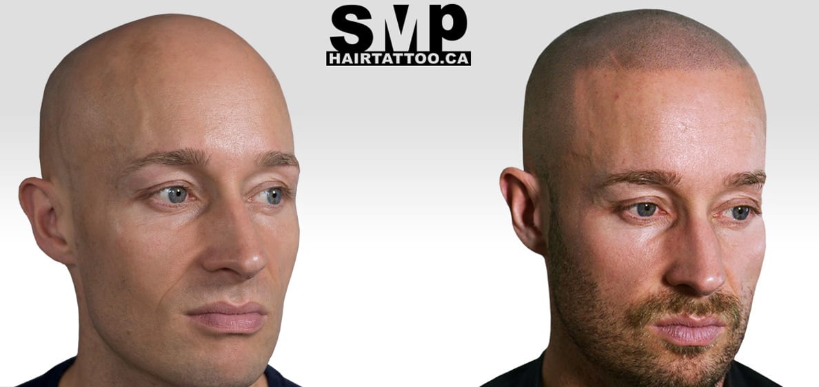 hair tattoo - scalp micropigmentation - scalp tattoo