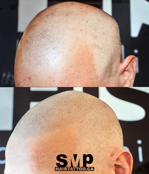 how long does scalp micropigmentation cost