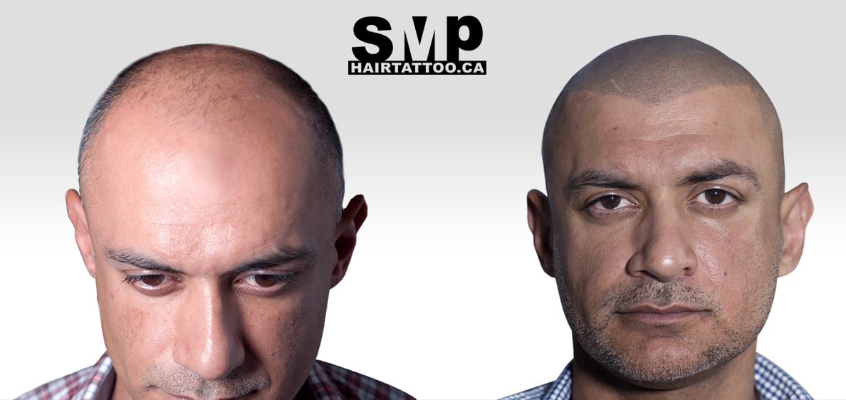 Scalp Micropigmentation Hairline Tattoo, What You Need To Know