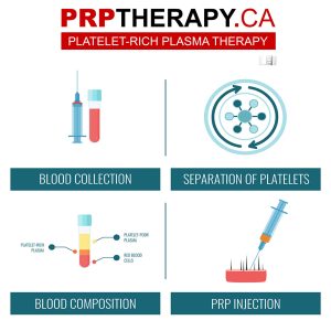 prp hair treatment success rate - prp hair treatment Toronto - PRP treatments near me