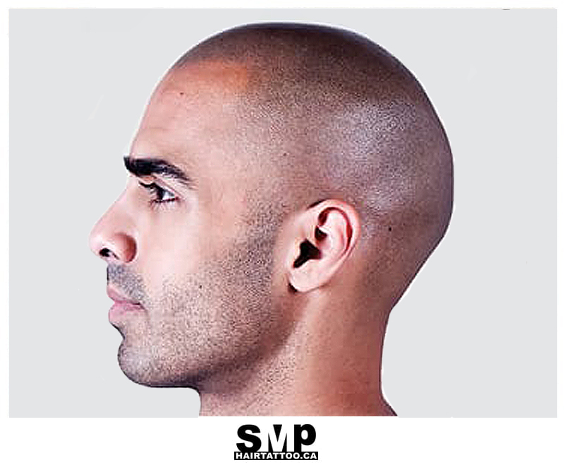 scalp-micropigmentation-Toronto
