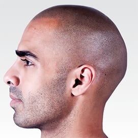 scalp micropigmentation Toronto