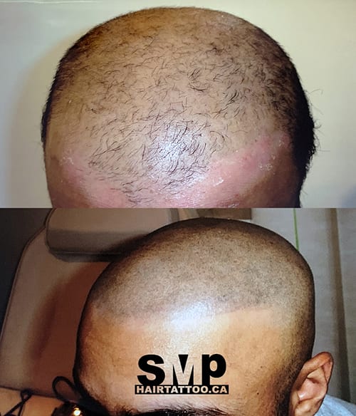 scalp micropigmentation cost canada