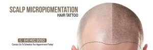 scalp micropigmentation - hair tattoo - hair loss clinic