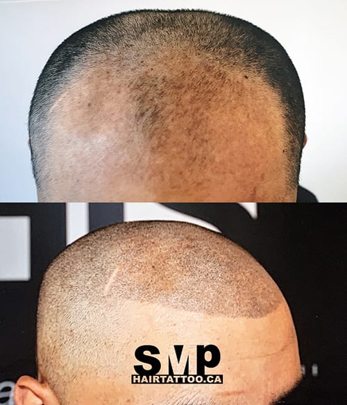 scalp micropigmentation ontario