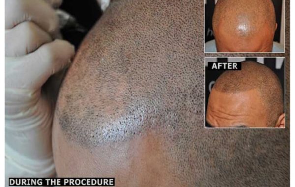 scalp micropigmentation fail