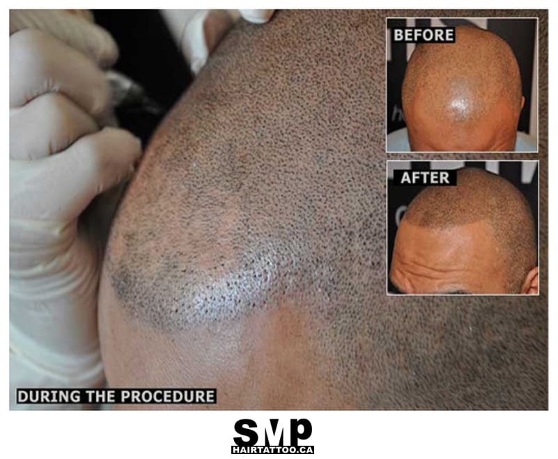 scalp micropigmentation fail