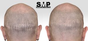 smp-scar-treatment-before-and-after