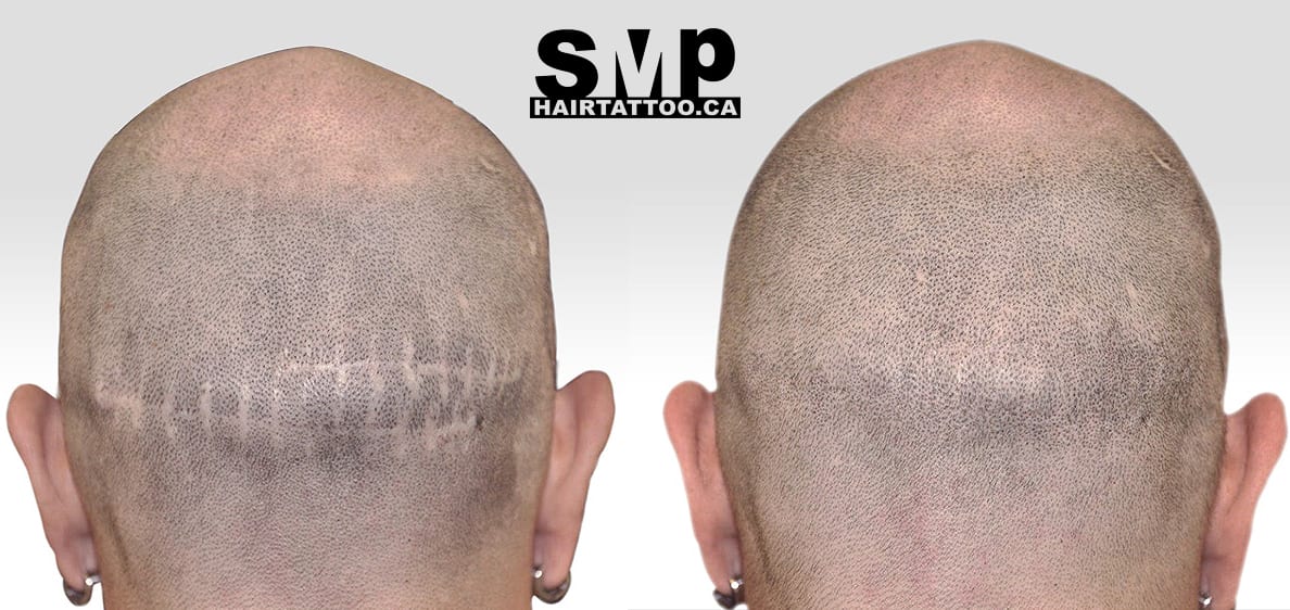Scalp Micropigmentation: Hair Tattoo Benefits, Before & After