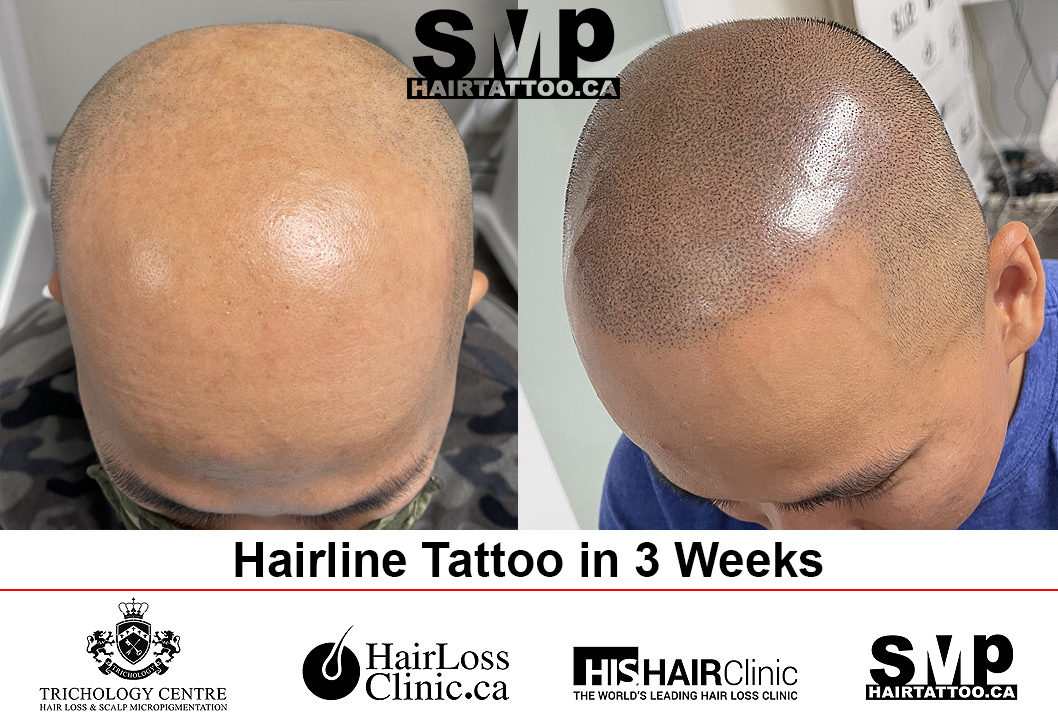 Nr.1 Hair Tattoo (SMP) Artist - Amazing Results by Agatha K.