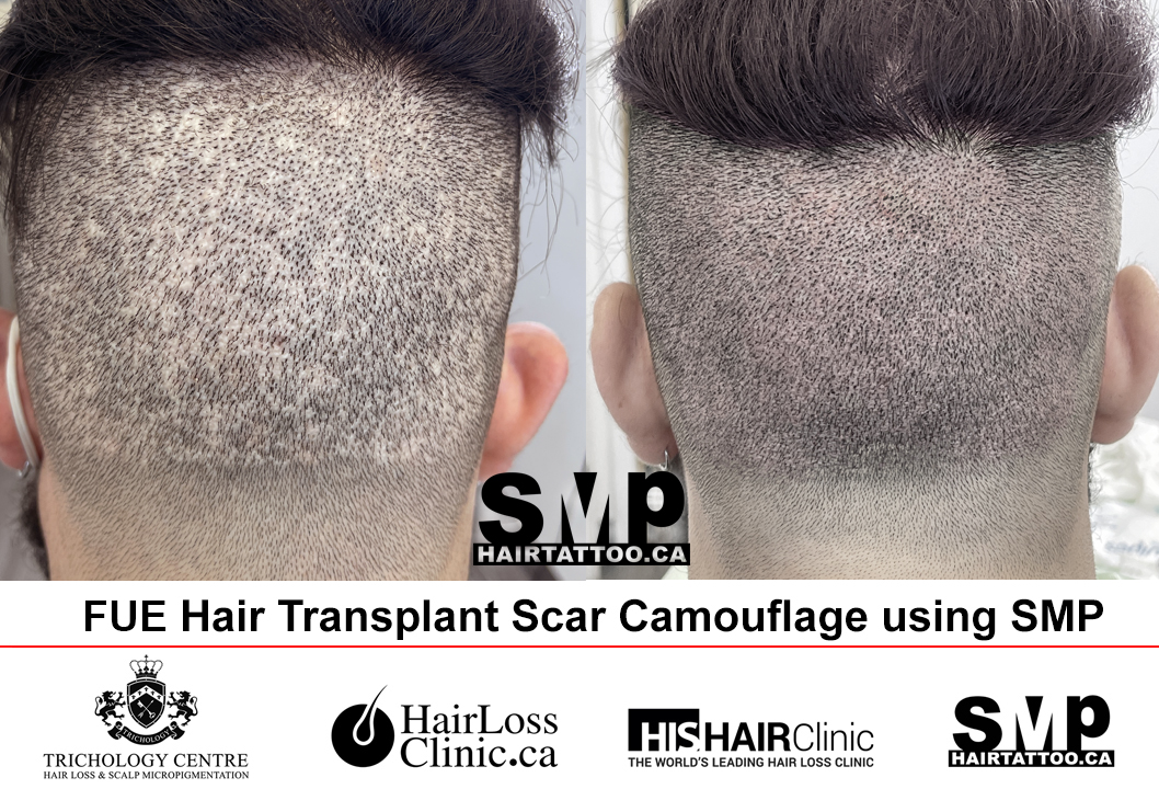 Micropigmentation Scalp for Hair Transplant Scars