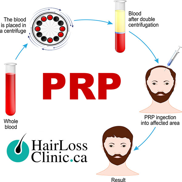 PRP-for-hair-loss