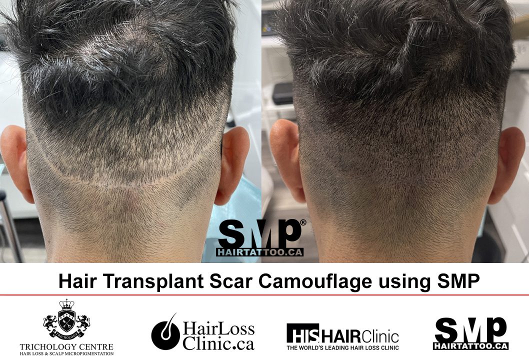 Scalp Micropigmentation Scar Tattoo