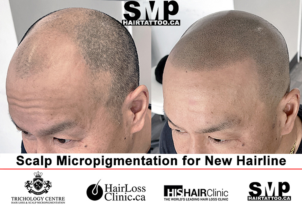 Scalp Micropigmentation Hairline Tattoo