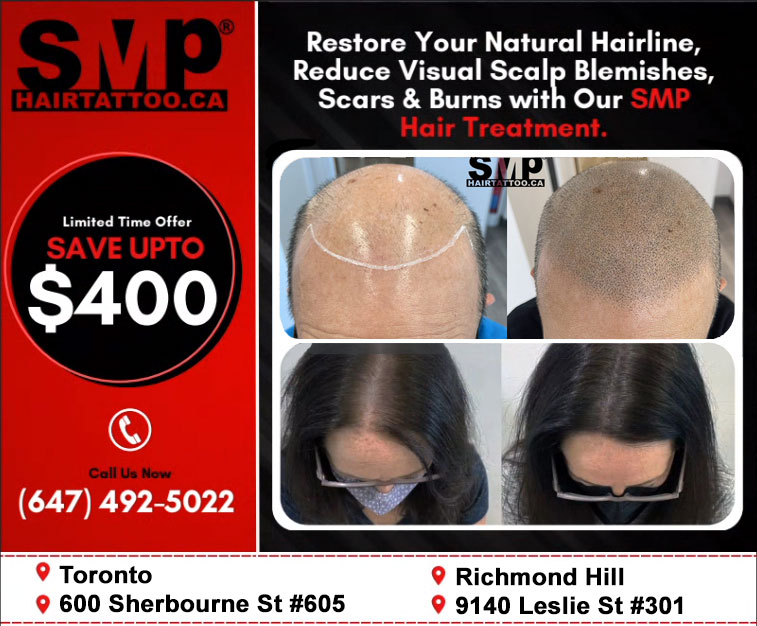 Scalp-Micropigmentation-Toronto