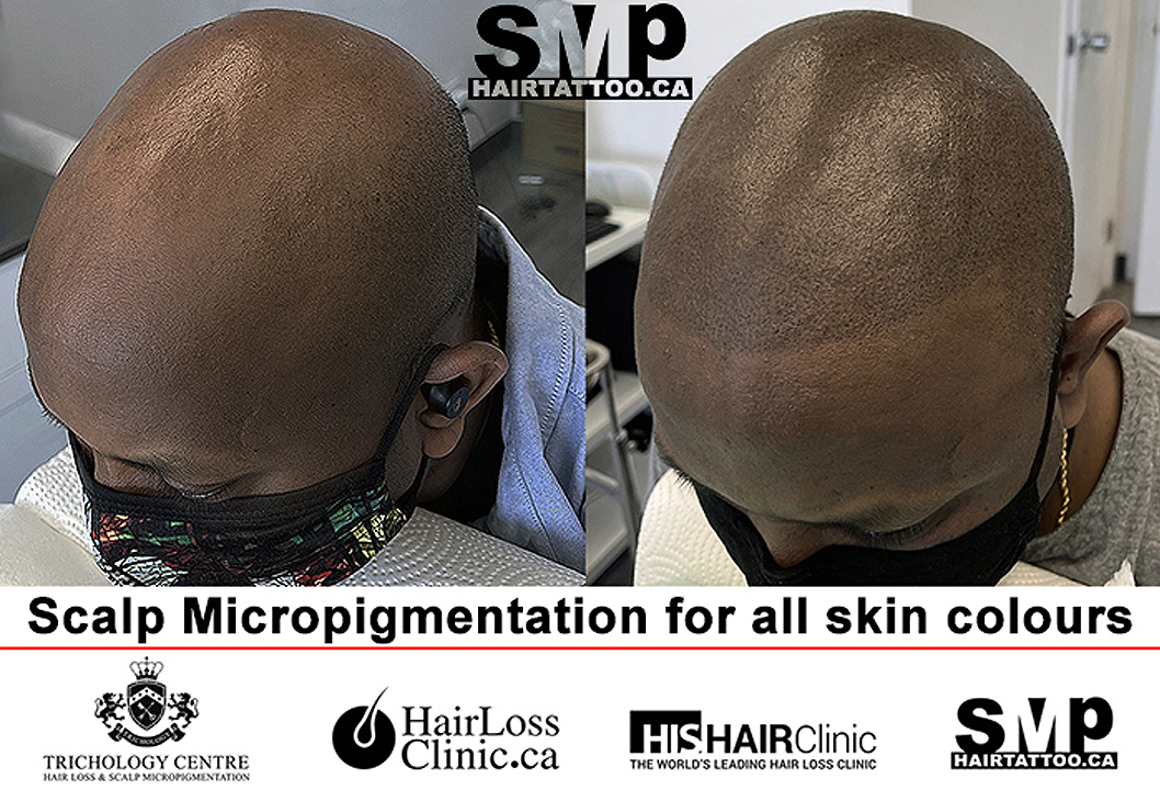 Scalp Micropigmentation for All Skin Colours