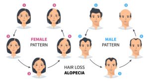 female pattern baldness - male pattern baldness
