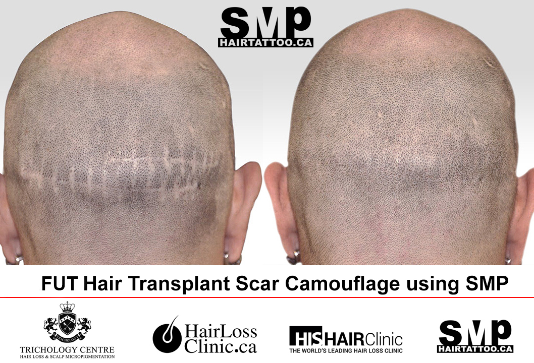 SCALP MICROPIGMENTATION The cosmetic hair tattoo treatment can cover bald  spots or thinning hair without surgery. If you are looking… | Instagram