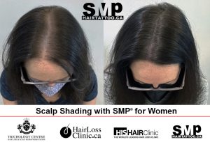 hair micropigmentation for women