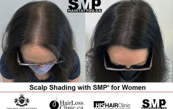 hair micropigmentation for women