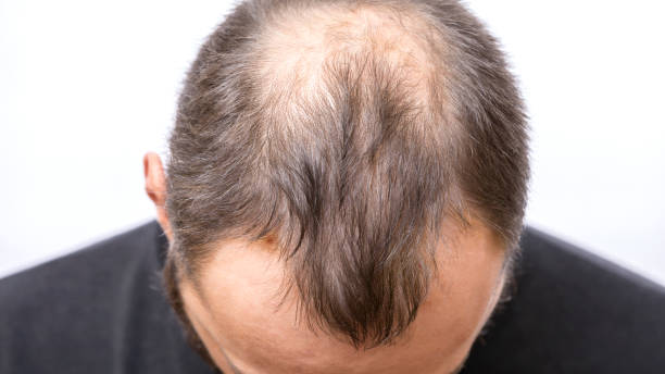 hair restoration toronto