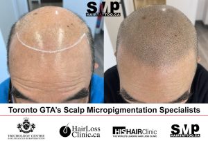 hair tattoo before and after SMP Toronto