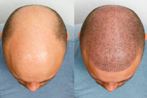 FUE Transplant Before & After