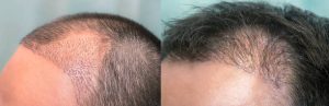 hair transplant Toronto - hair transplant before and after