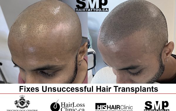 hair-transplant-repair