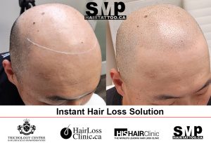 instant-hair-loss-solution